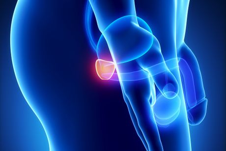 Rak prostate Rak prostate